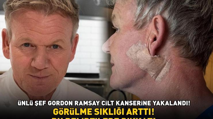 Ünlü şef Gordon Ramsay cilt kanserine yakalandı Son 10 yılda Türkiyede de görülme sıklığı arttı Bu belirtilere dikkat