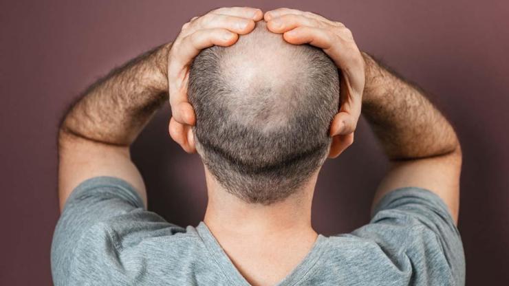 HER ÇAĞIN SORUNU: SAÇ DÖKÜLMESİ VE KELLİK Antik Uygarlıklardan Günümüze Denenmeyen Yöntem Kalmadı Büyü, İksirler, Muz, Hayvan Gübresi... Duyunca Çok Şaşıracaksınız