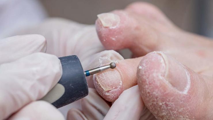 Şeker Hastalarına Uyarı: Tırnaklarınızı Böyle Kesiyorsanız Aman Dikkat Ayak Enfeksiyonuna Zemin Hazırlıyor