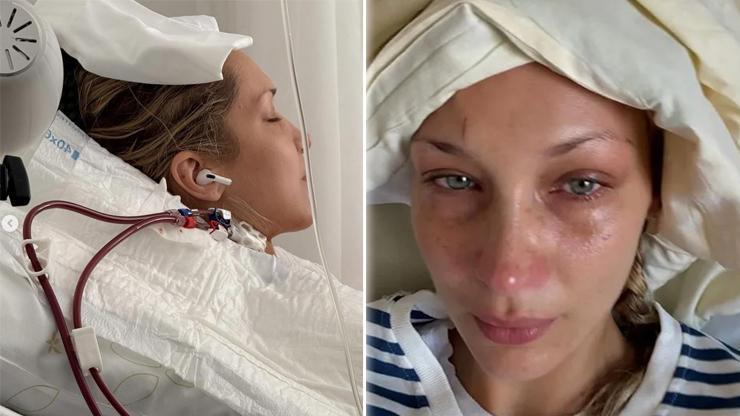 Ünlü Manken Bella Hadid Bu Hastalıkla Mücadele Ediyor Griple Karıştırılıyor Belirtileri Cilt Kızarıklığı ve Halsizlikle Sınırlı Değil Tedavi Edilmediğinde Kalıcı ve Ağır Tablolarla İlerleyebilir... İŞTE O HASTALIK