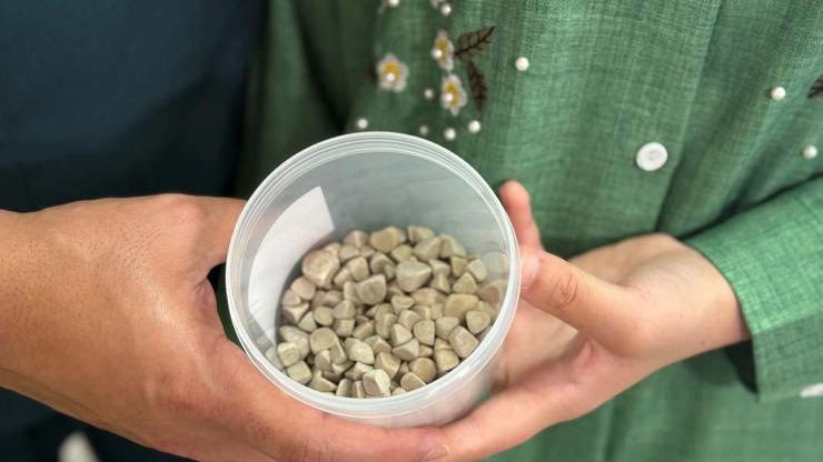 Vücudundan 287 tane taş çıkarıldı, doktorlar bile şok oldu: Literatürde çok nadir görülen bir olay