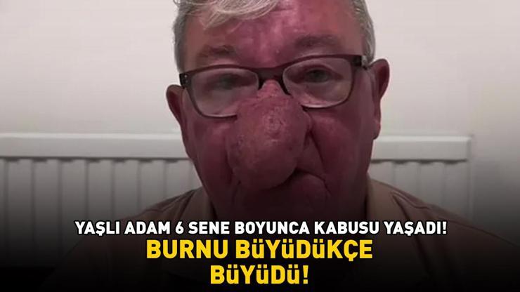 Burnu büyüdükçe büyüdü! 68 yaşındaki adam kabusu yaşadı! 4 saatlik operasyonla adeta yeniden doğdu Burnu büyüdükçe büyüdü! 68 yaşındaki adam kabusu yaşadı! 4 saatlik operasyonla adeta yeniden doğdu