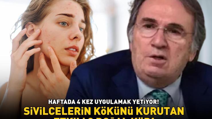 Prof. Dr. İbrahim Saraçoğlu’ndan sivilcelerin kökünü kurutan etkili 3 kür HAFTADA 4 KEZ UYGULAMAK YETİYOR