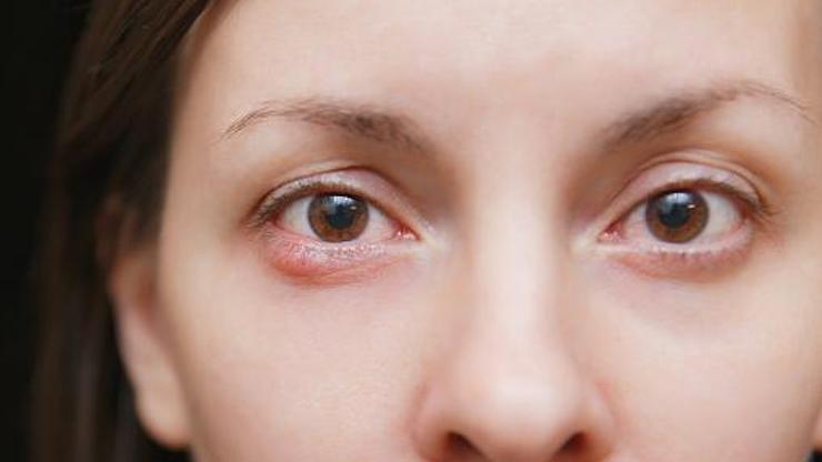 Kış Aylarında Göz Enfeksiyonlarına Dikkat Uzmanlardan Önemli Uyarı