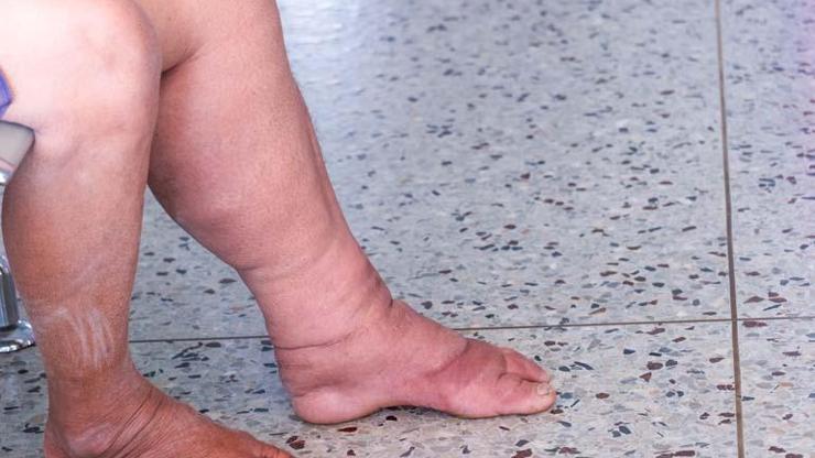 Bir Ayağınızın Numarası Diğerinden Büyükse Dikkat Bu Hastalığın Sinyali Olabilir