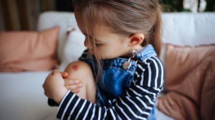 Çocuklarda Halsizlik ve Morluklara Dikkat: Löseminin İlk Sinyali Olabilir