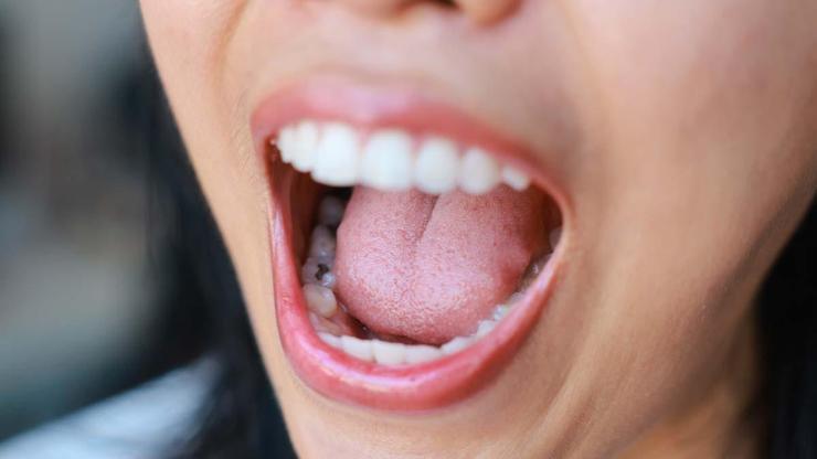 Türkiye’de alarm veren tablo: 10 kişiden 7’si yaşıyor Uzmanlar uyarıyor: “Diş fırçalarken bu belirti asla normal değildir”