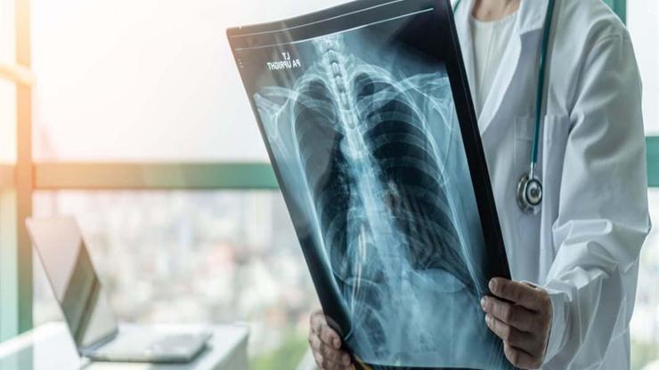 SÜPERENFEKSİYON Uyarısı: Belki de Zatürre Oldunuz Ama Farkında Değilsiniz Bu Belirtilere Dikkat