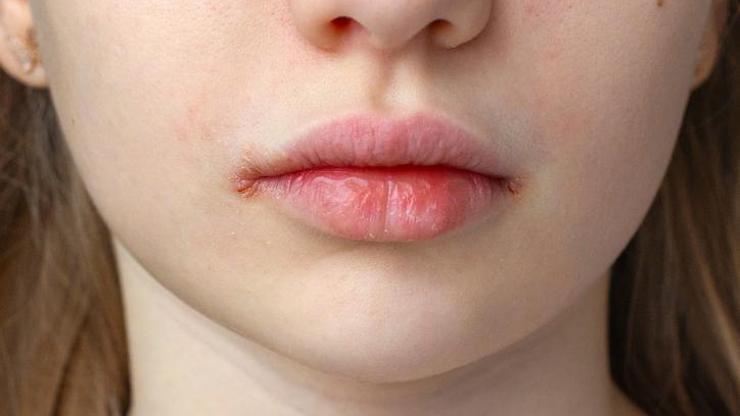 Dudak çatlaması tarihe karışacak Meğer dudak çatlamasının önüne geçmek çok basitmiş