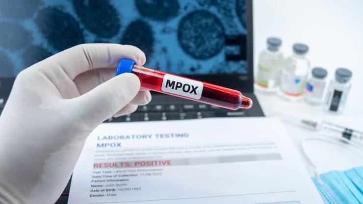 Maymun çiçeği virüsünde yeni varyant tespit edildi Maymun çiçeği virüsünde yeni varyant tespit edildi