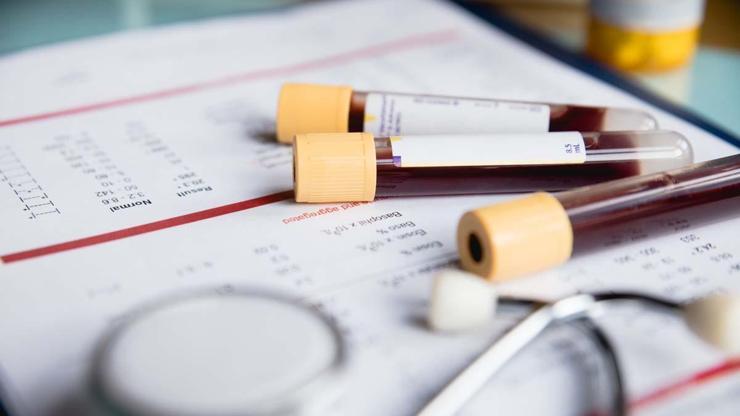 KAN TESTİ İLE TESPİT EDİLEN HASTALIKLAR: Kansızlık, Demir ve B12 Eksikliği, Pıhtı Atması... Basit Bir Kan Sayımı İle Bu Hastalıkları Teşhis Etmek Mümkün