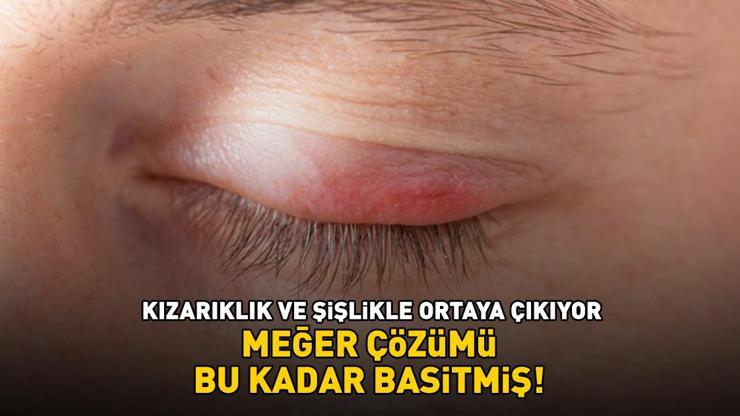 Göz kapağı iltihabına ne iyi gelir? Kızarıklık ve şişlikle ortaya çıkıyor! Meğer çözümü bu kadar basitmiş Göz kapağı iltihabına ne iyi gelir? Kızarıklık ve şişlikle ortaya çıkıyor! Meğer çözümü bu kadar basitmiş