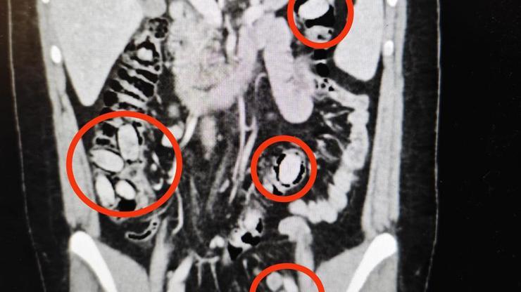 Polisin şüphesi üzerine durduruldu Midesinden çıkanlar şoke etti