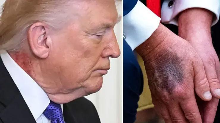 Önce eli şimdi de boynu: Trump'ın doktorundan açıklama
