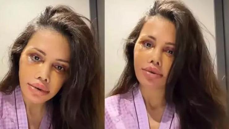 Didem Ceran’dan şaşırtan paylaşım Yüz ameliyatı sonrası kaşında saç çıktı