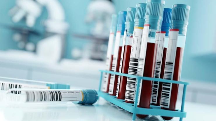 Alzheimer Teşhisinde Yeni Nesil Kan Testi Hafıza Hırsızını Unutkanlık Başlamadan 20 Yıl Önce Yakalamak Artık Mümkün