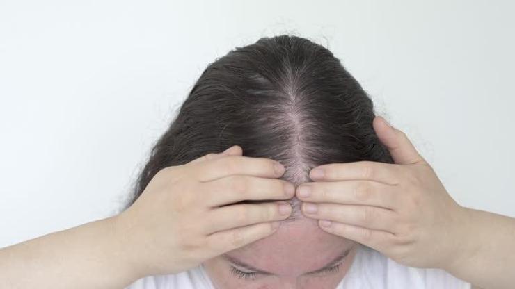 Uzmandan saç dökülmesi uyarısı: Rastgele vitamin kullanmak sorunu büyütebilir