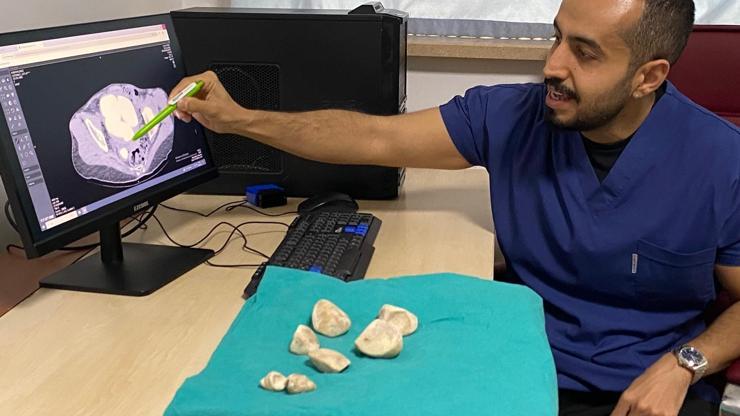 İdrar kanalı ve mesaneden yarım kiloya yakın 6 taş çıkarıldı Doktorlar bile şaşkına döndü