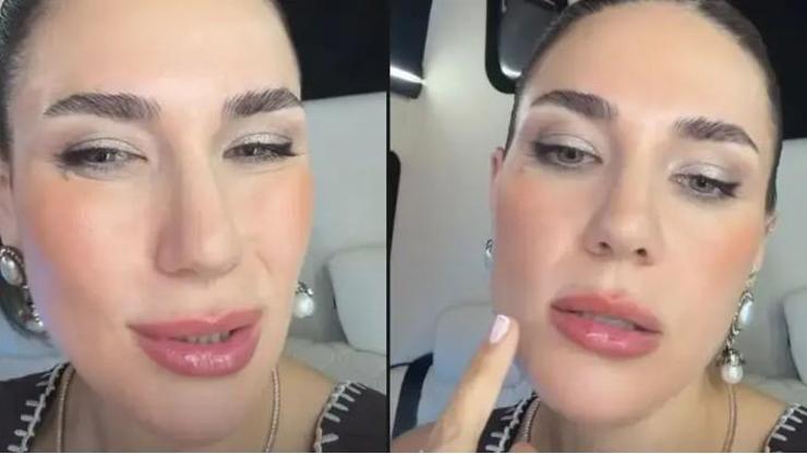 Buse Varol’dan Estetik Açıklaması: “BOTOKSU İKİ GÜN ÖNCE YAPTIRDIM”