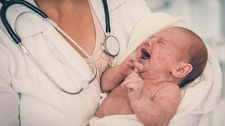 Birçok Ebeveyn Fark Etmiyor: Çocuklarda Hızla Yayılan Viral Tehlike Masum Bir Döküntü Sandığınız Şey Daha Ciddi Olabilir