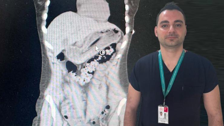 Zayıflamak İsterken Kabusu Yaşadı: Midesinden 13 Santimetrelik Diş Fırçası Çıktı... İşte Doktorları Şaşkına Çeviren Olay