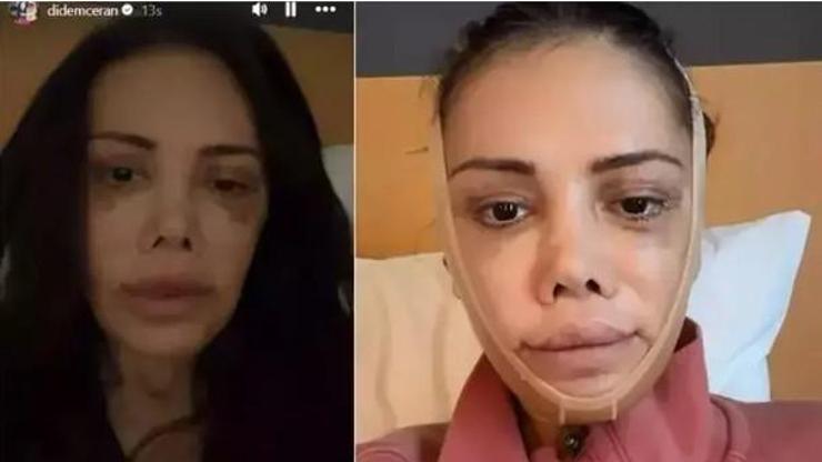 Yüz nakli sonrası değişimiyle gündemdeydi Didem Ceran kendisini dünyaca ünlü yıldızla kıyasladı