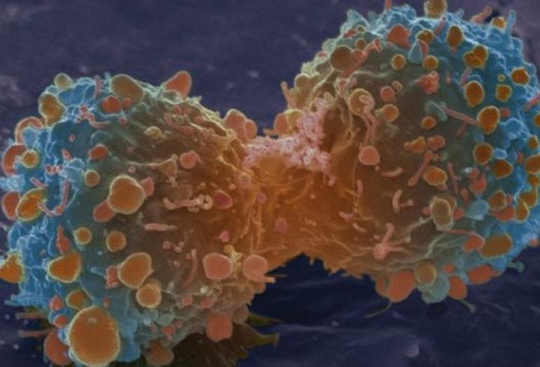 Beyin kanseri tedavisinde  Türk bilimadamının başarısı
