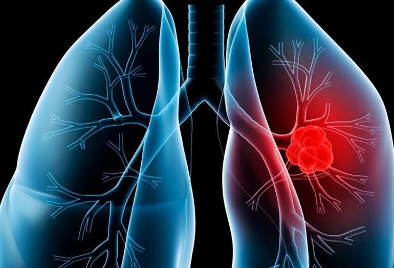 Türkiye’de her yıl 18 bin kişiye akciğer kanseri teşhisi konuluyor