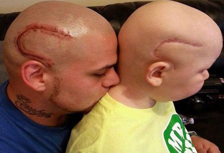 Beyin ameliyatı olan oğluna destek  için dövme yaptırdı
