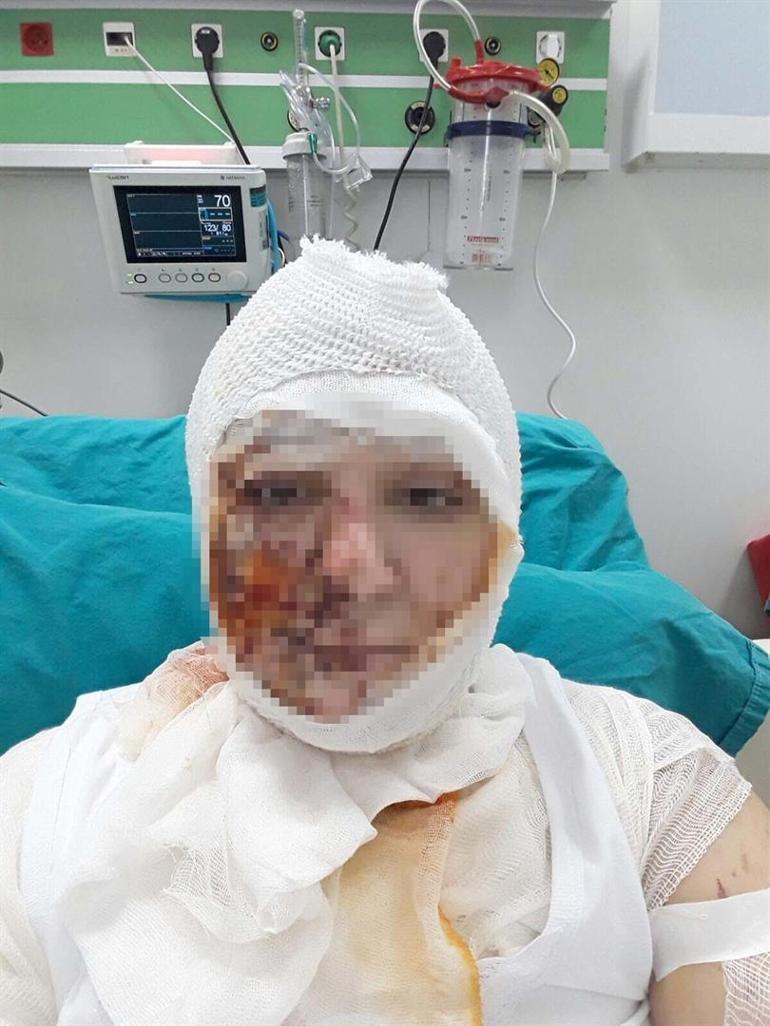Önce cinsel saldırıya uğradı, ardından kezzap dökülerek yakıldı