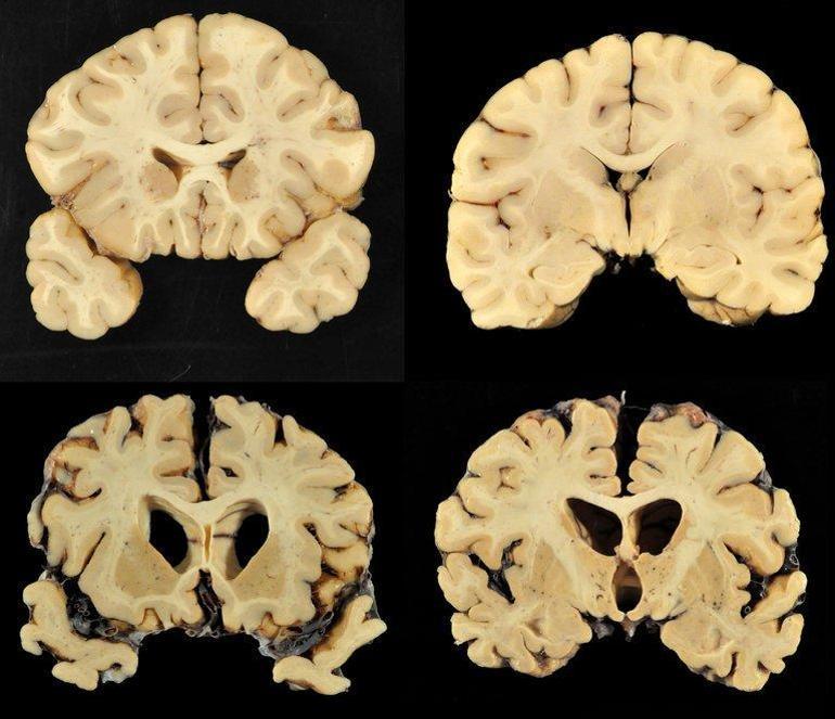 Beyin travmasının neden olduğu gizemli hastalık