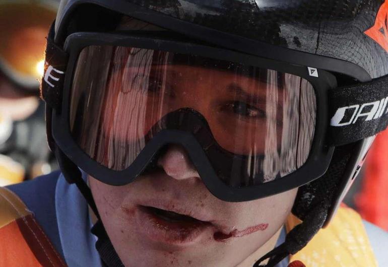 Rus kayakçının yüzü kanlar içinde kaldı
