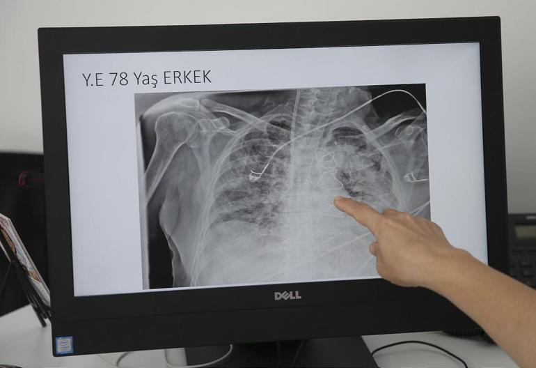 Koronavirüsün akciğerdeki ağır tahribatı, hastaların tomografi görüntülerine yansıdı | Video