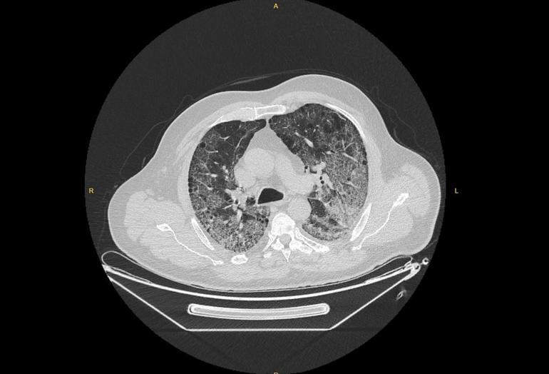 Koronavirüsün akciğerdeki ağır tahribatı, hastaların tomografi görüntülerine yansıdı | Video