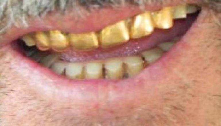 Son dakika.. Ameliyat öncesi teslim ettikleri altın dişler başka hastaya verilmiş