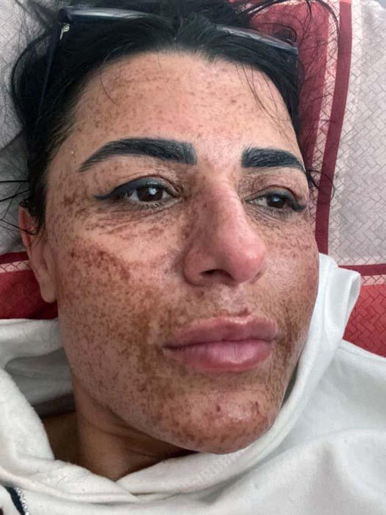 Estetik uğruna yüzü yanan kadın, aynalarla barıştı