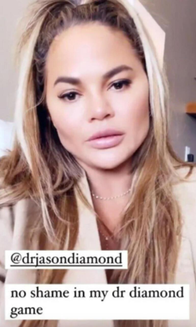 Chrissy Teigen yanaklarındaki yağları aldırdı