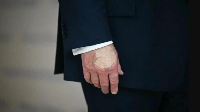 Trump’ın elindeki morluk yine olay oldu