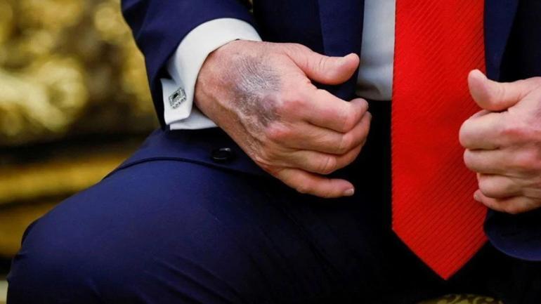 Trump’ın elindeki morluk yine olay oldu