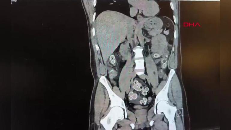 Midesinde paket paket uyuşturucu taşıdı