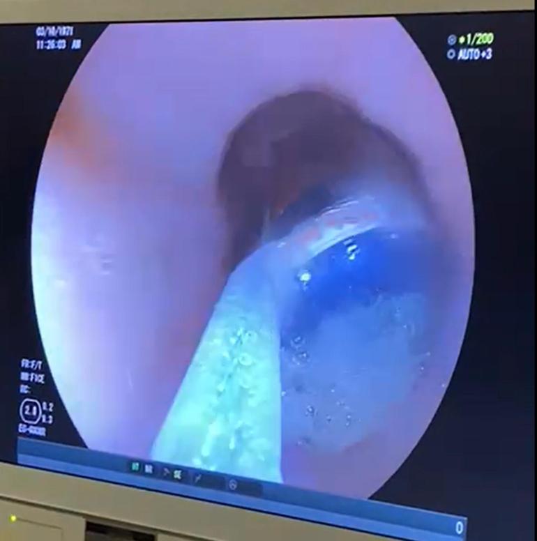 Ağrıda cezaevinde şok eden olay Mahkumun midesinden çıkanlar doktorları hayrete düşürdü...