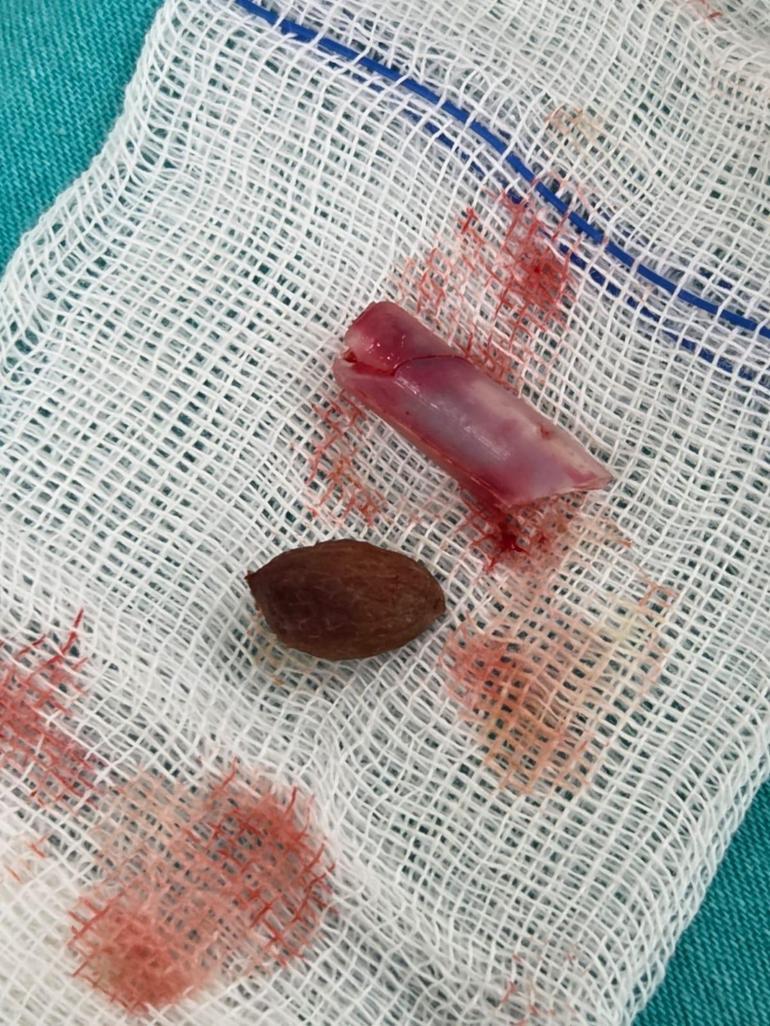 Doktorlar şaştı kaldı Burnundaki kaşıntının nedeni şoke etti