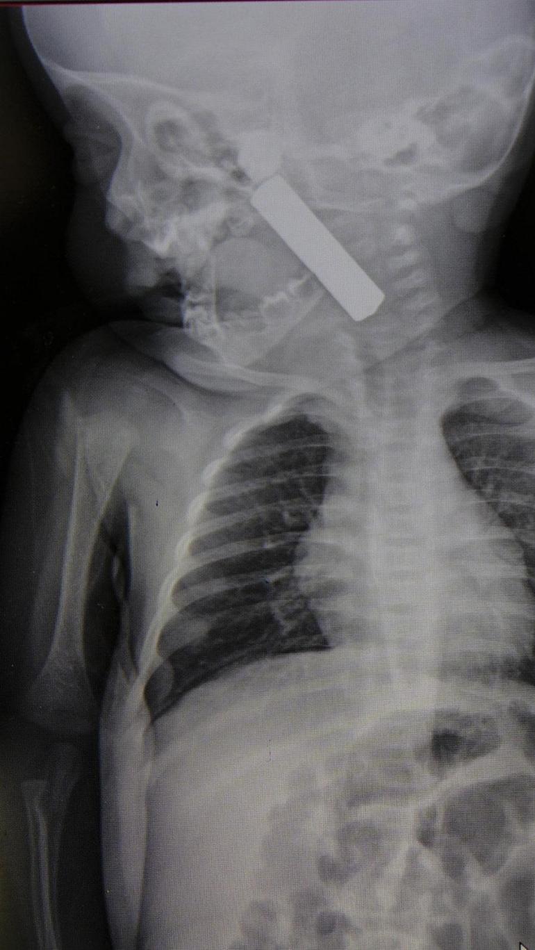 6 aylık bebeğin boğazına kumanda pili kaçtı