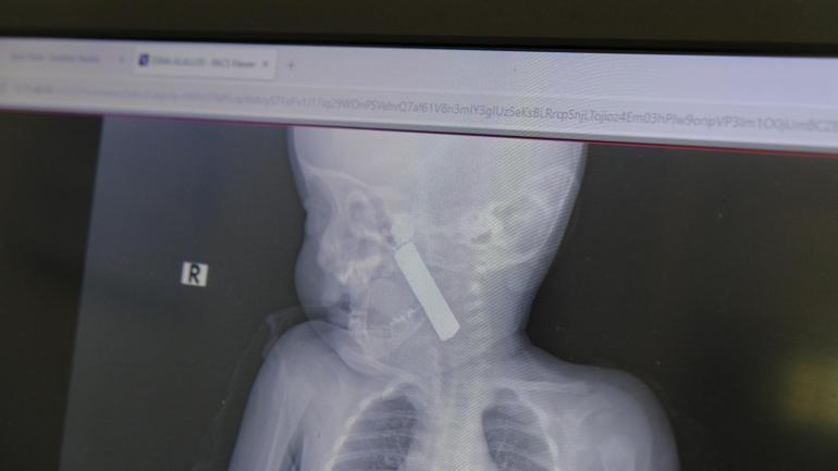 6 aylık bebeğin boğazına kumanda pili kaçtı