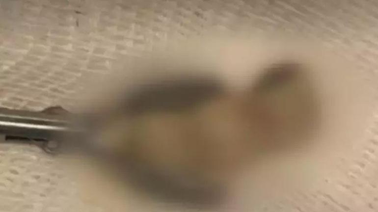 Röntgende hayatının şokunu yaşadı Dişi akciğerine kaçtı