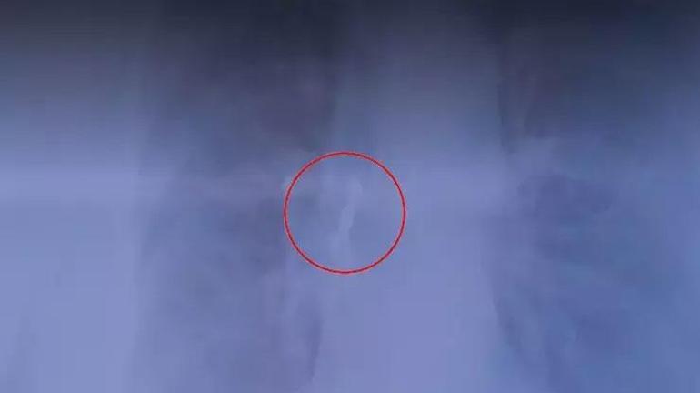 Röntgende hayatının şokunu yaşadı Dişi akciğerine kaçtı