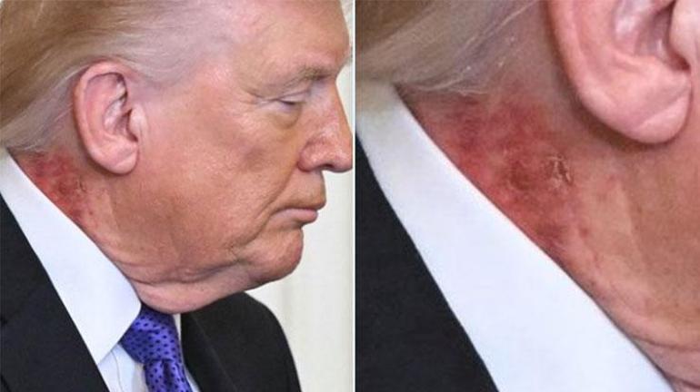 Önce eli şimdi de boynu: Trumpın doktorundan açıklama