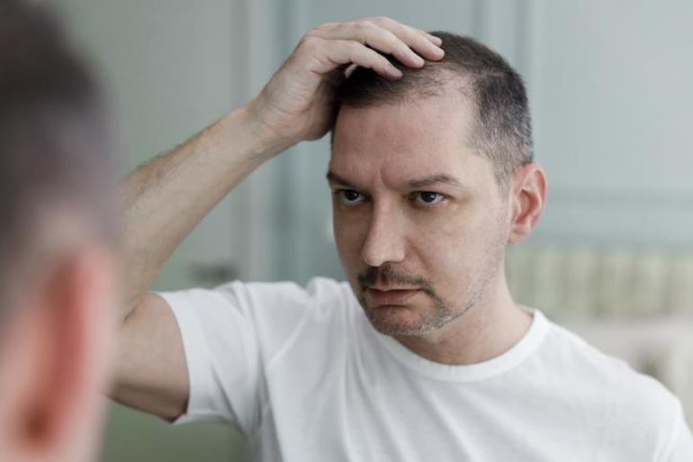 Erkekleri kelliğe sürükleyen gizli tehlike Herkes içiyor ama sonuç felaket: Saçları avuç avuç döküyor